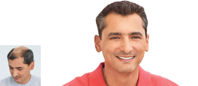 斑秃脱发是什么原因造成的？信息